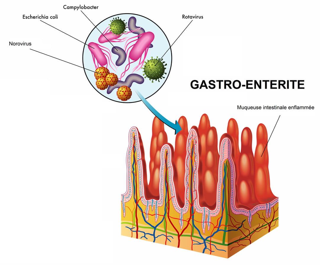 gastro-entérite